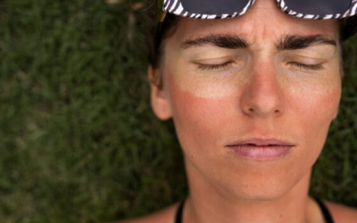 portrait-adult-woman-with-sunburn-skin